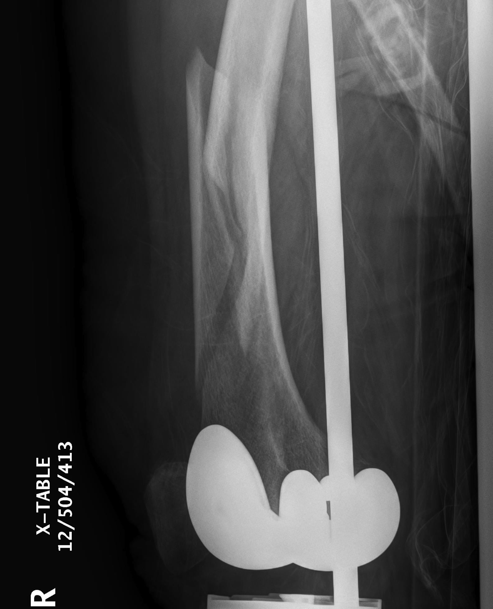 TKR Periprosthetic Fracture